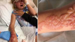 Den kun 7 år gamle pige fik forbrændt hånden frygteligt, efter at hun lavede en 